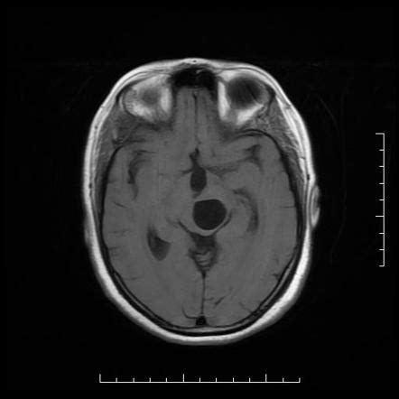 Neuroglial cyst of brainstem | Image | Radiopaedia.org