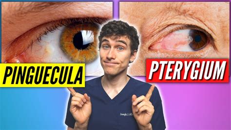 Pinguecula Vs Pterygium (Signs, Symptoms, Treatment)