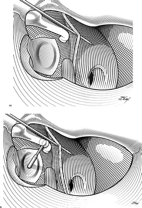 Perilymph Fistula Repair | Ento Key