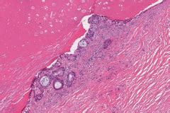 Mucoepidermoid carcinoma | Ottawa Atlas of Pathology