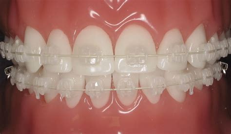 Ceramic Braces | Advantages, Costs & More | Orthodontics