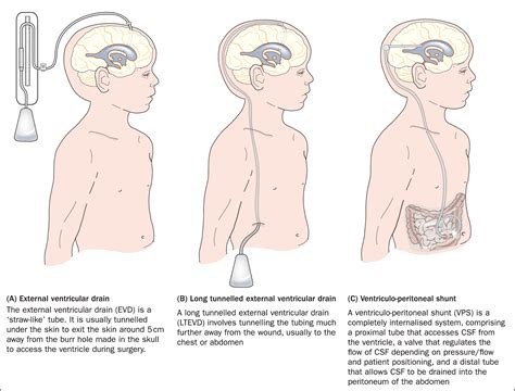 Ventricular Peritoneal Shunt