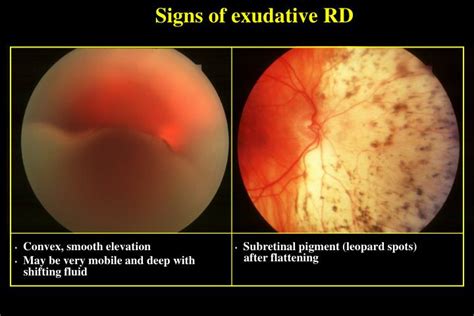 PPT - PATHOGENESIS AND SIGNS OF RETINAL DETACHMENT (RD) PowerPoint ...