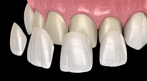 A Complete Guide to the Different Types of Veneers - Newbury Dental Group