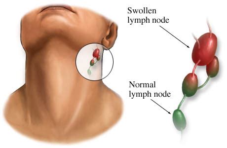 Lymph Node Locations - Neck, Groin, Ear, Diagram, Pictures | Diseases Pictures