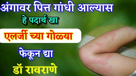 diet plan for chronic urticaria Iअंगावर पित्त,गांधी येत असल्यास काय ...