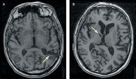 Silent brain infarcts: a systematic review - The Lancet Neurology