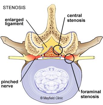 Bilateral Neural Foraminal Stenosis at T9 Vertebra - Rxharun