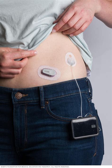 A1C Test Vs. Daily Blood Glucose Monitoring - Diabetes Clinic San Antonio