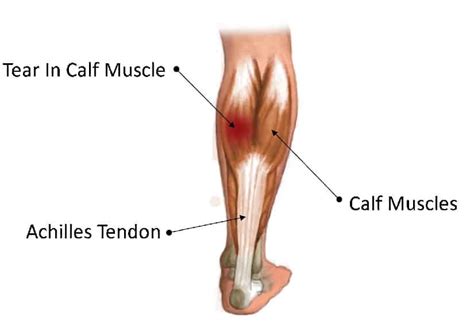 Calf muscle pain cause and treatment with exercises for relief