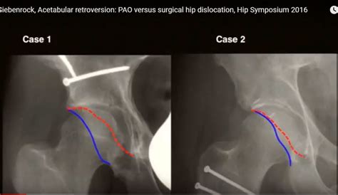 Acetabular Retroversion: PAO versus Surgical hip dislocation — OrthopaedicPrinciples.com