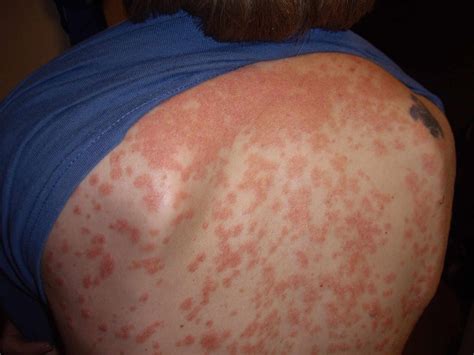 Plaque Psoriasis: Photos and Symptoms From Head to Toe