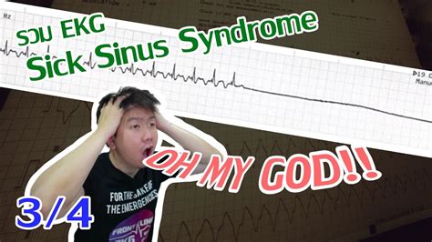 Ekg Tracing With Sick Sinus Syndrome | SexiezPicz Web Porn