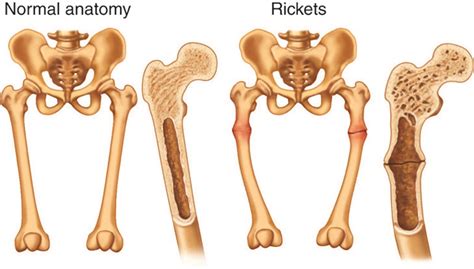 Guide to Osteomalacia – All About Bone Health and Joint Care