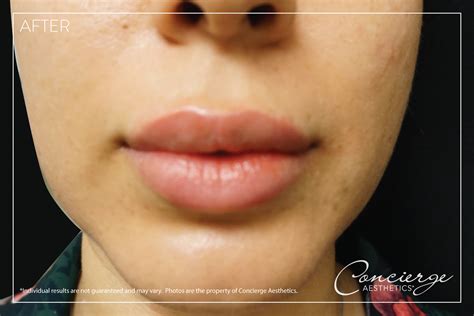 Before and After - Juvederm Volbella - Lips (29 yo) Concierge Aesthetics