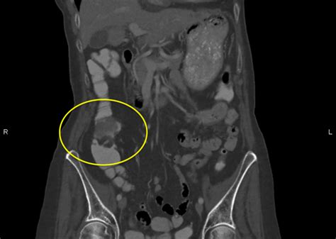 Association of Streptococcus sanguinis Infection With Colorectal Carcinoma | Consultant360