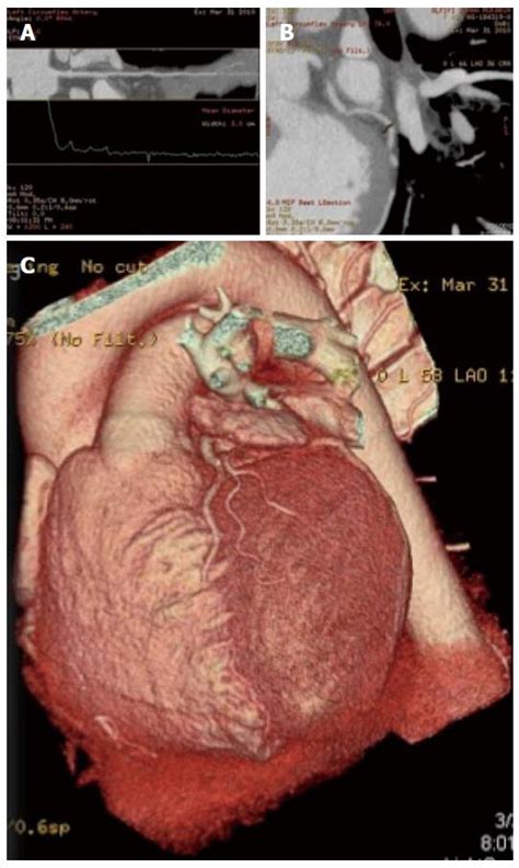 Myocardial bridging analysis by coronary computed tomographic ...