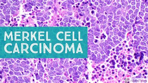 Merkel Cell Carcinoma Histology