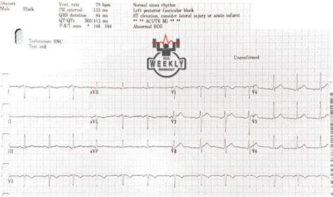 ECG Basics & Fundamentals: diagnostic criteria for acute pericarditis – ECG Weekly