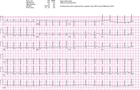 Paroxysmal Atrial Tachycardia Vs Sinus Tachycardia