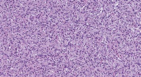 Dermatofibrosarcoma protuberans | Ottawa Atlas of Pathology