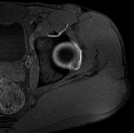 Acetabular Labrum Mri