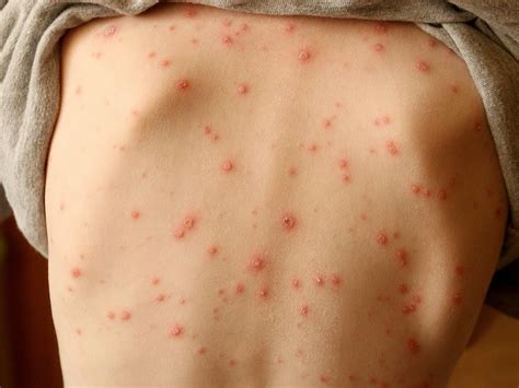 Skin rash should be considered key symptom of coronavirus, say ...