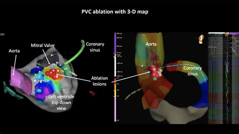 PVC VT Ablation - Melbourne Heart Group