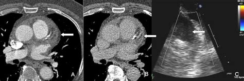 Left atrial appendage thrombus. There is a filling defect in the left ...