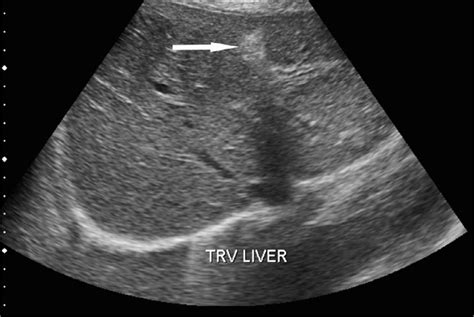 Falciform Ligament Ultrasound