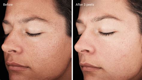 Chemical Peels for Acne Scars: Efficacy, Before and Afters, At-Home Uses