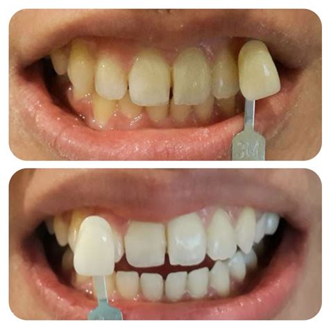 external-bleaching | Audy Dental