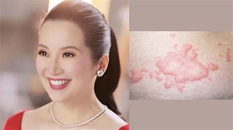 Stress triggers this distressing skin condition | PEP.ph