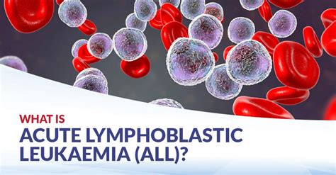 What is Acute Lymphoblastic Leukaemia (ALL)? | CFCH | Centre for ...