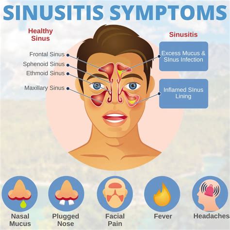 Sinusitis Symptoms | Sinusitis, Sinus problems, Sinus relief