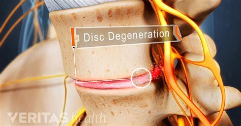 3 Things You Need to Know About Lumbar Degenerative Disc Disease