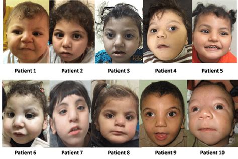 Facial photos of our 10 patients. Note the closed distinct facial... | Download Scientific Diagram