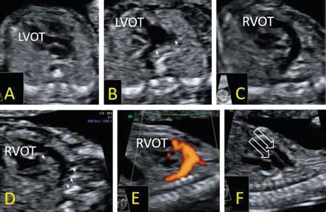 Fetal Lvot Ultrasound