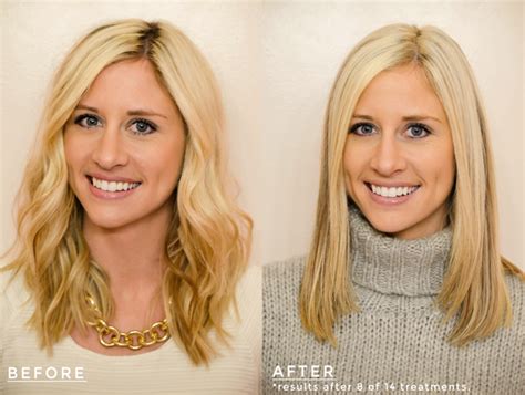 Crest White Strips Before And After - All You Need Infos