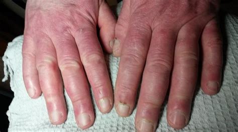 Systemic Sclerosis or Systemic Scleroderma: What is it? Symptoms and Causes - Scope Heal