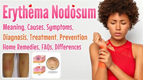 Erythema Nodosum meaning, causes, symptoms, diagnosis, treatment, prevention, home remedies ...