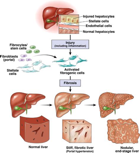 Noninvasive Assessment of Liver Fibrosis and Portal Hypertension With Transient Elastography ...