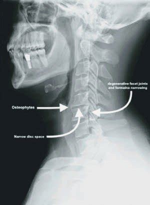 Diagnosis and Special Tests for Cervical Spondylosis - PT Master Guide