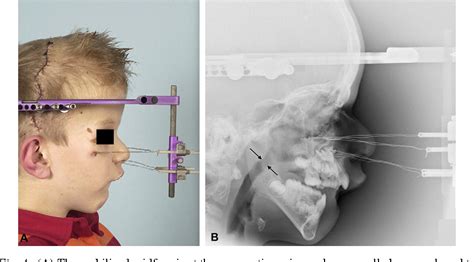 Figure 4 from Advancement of the midface, from conventional Le Fort III ...