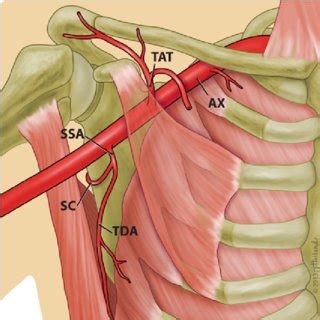 a type I-lateral thoracic branches (LTA) of the thoracoacromial artery ...