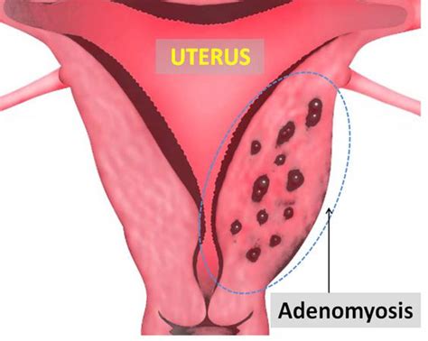 Some Effective Ways to Let Adenomyosis Pain Relief-TCM and Health