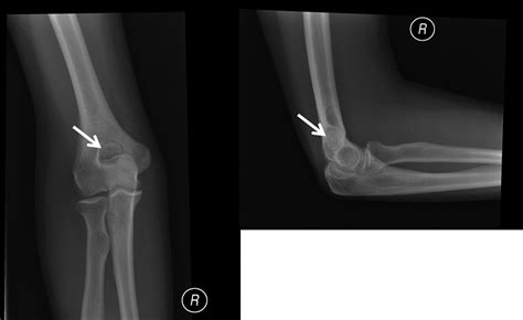 Single extremely large loose body in olecranon fossa in a young patient | BMJ Case Reports