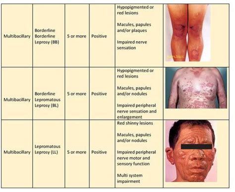 Signs and Symptoms - Leprosy