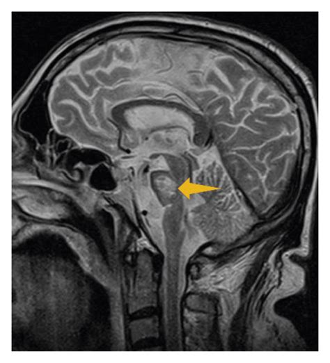 MRI images show central pontine T1 moderately hypointense areas (a), T2... | Download Scientific ...