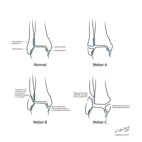 Weber classification of ankle fractures | Radiology Reference Article ...